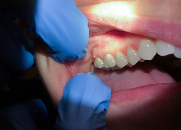 Best Emergency Broken Tooth Repair in Steger, IL