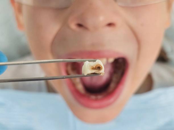 Best Emergency Broken Tooth Repair in Steger, IL